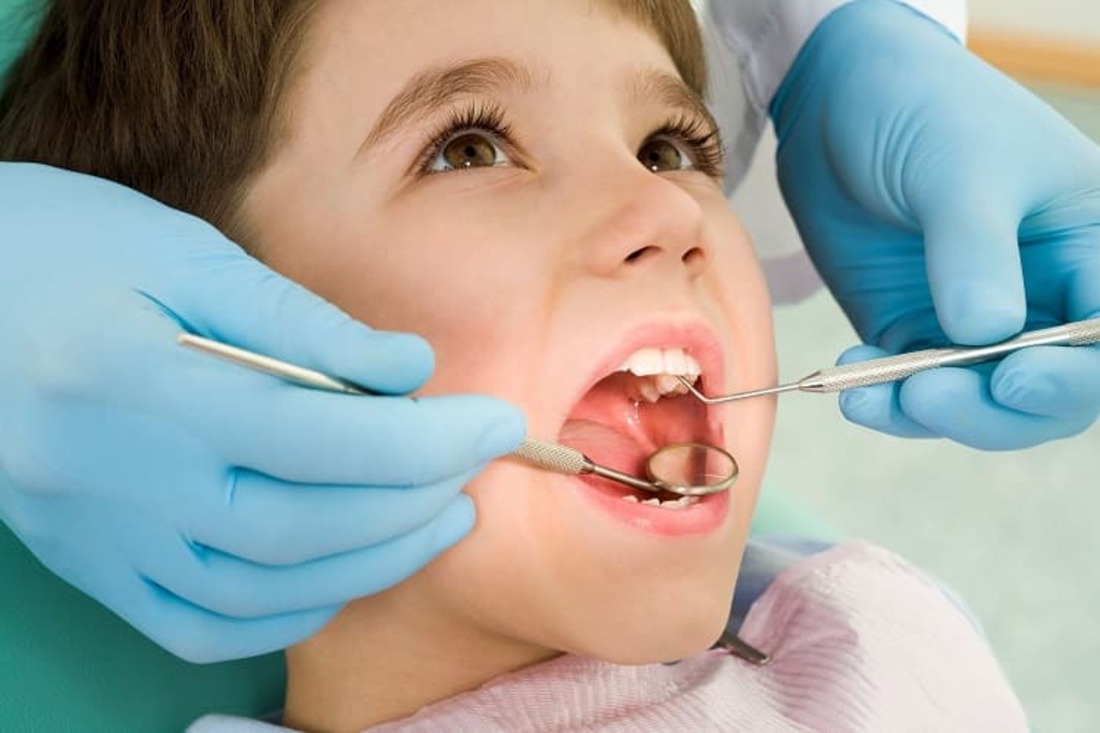 В Україні дітям можна безкоштовно полікувати зуби: перелік послуг