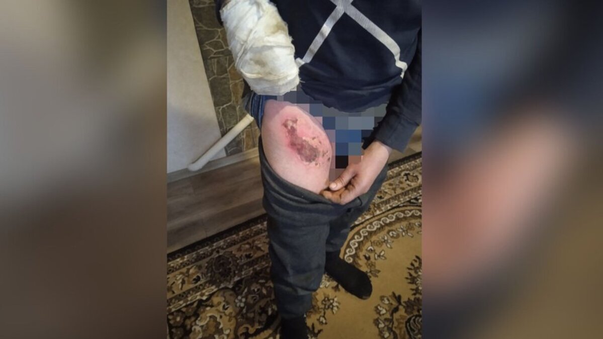 Парубки підпалили чоловіка і виклали відео у мережу - поліція встановлює обставини події на Черкащині