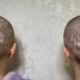 Без шкіри і волосся: 13-річні сестри довели себе до жахливого стану вітамінами