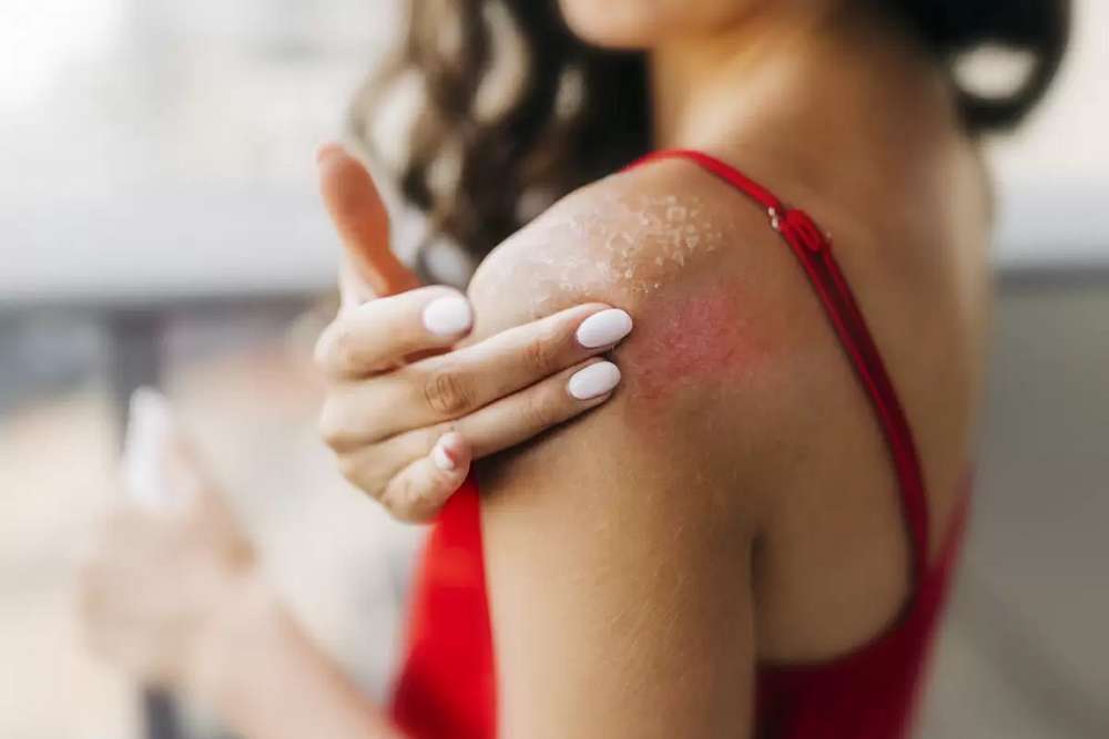 Чи існує алергія на сонце і як захисти шкіру від ультрафіолету