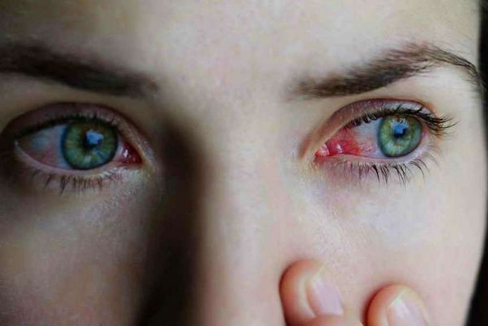 Що таке синдром червоного ока
