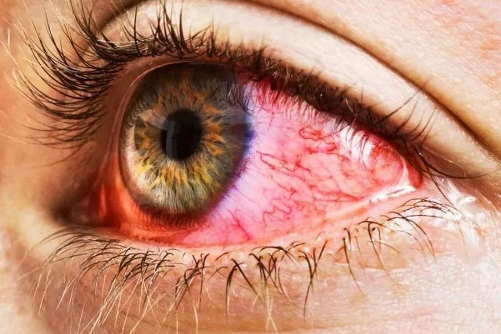 Що таке синдром червоного ока1