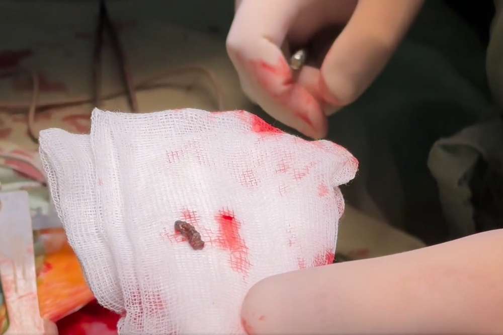 Лікарі дістали з серця 4-річної дівчинки уламок російської міни – що відомо про операцію (відео)