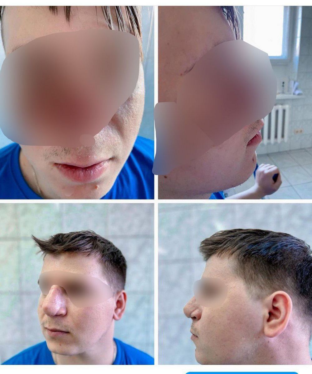 Лікарі відновили ніс військовому з ребра деталі унікальної операції (фото)